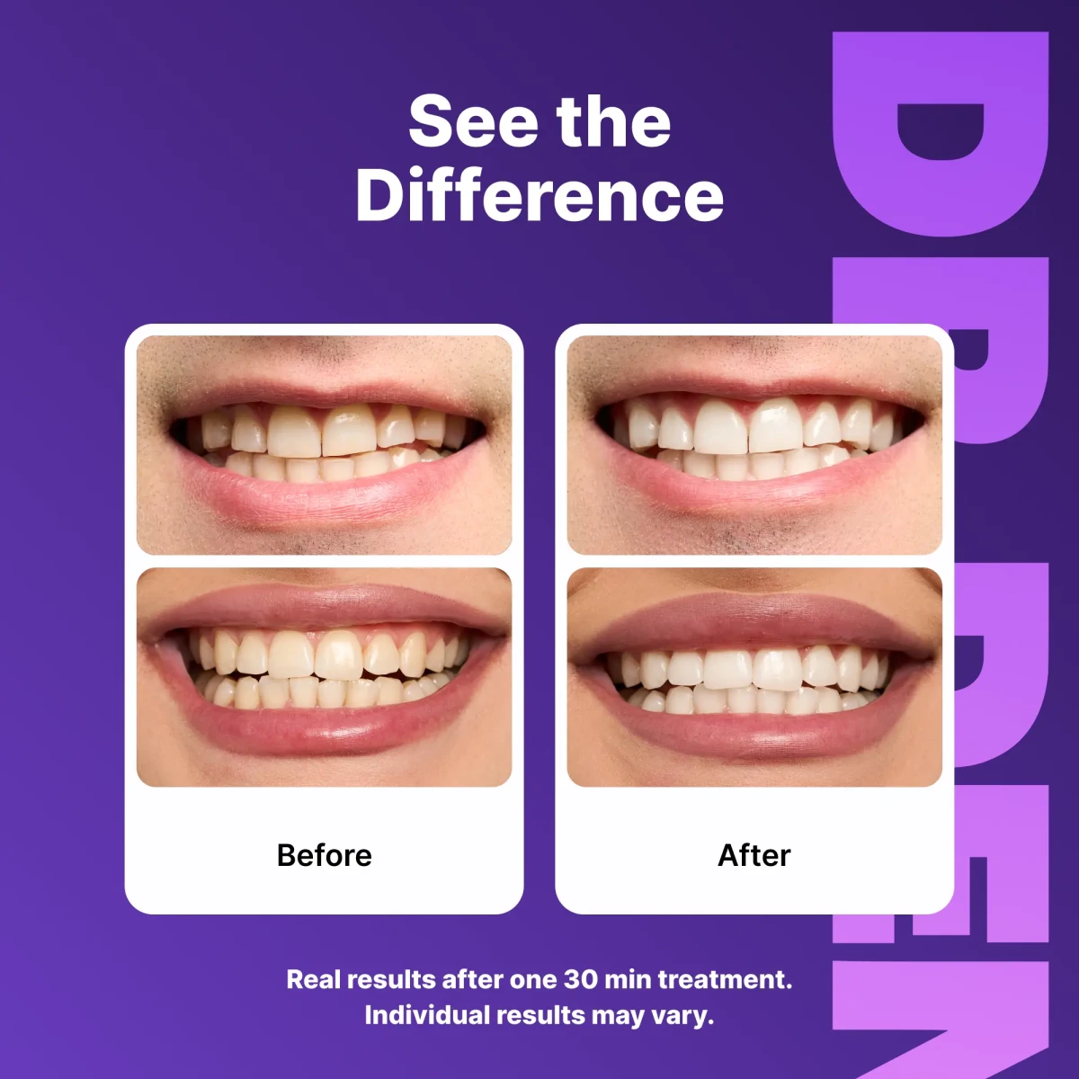 SmileKit™ Teeth Whitening Strips - Fast Results, Zero Sensitivity