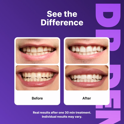 SmileKit™ Teeth Whitening Strips - Fast Results, Zero Sensitivity