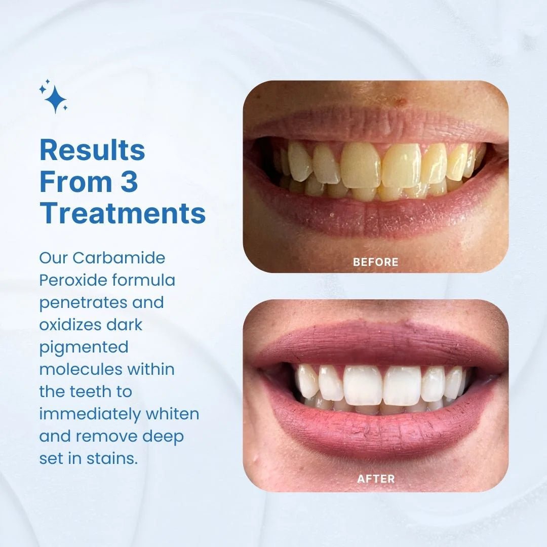 Transform Your Smile in Just 7 Minutes with Our Advanced Teeth Whitening Kit - Velora